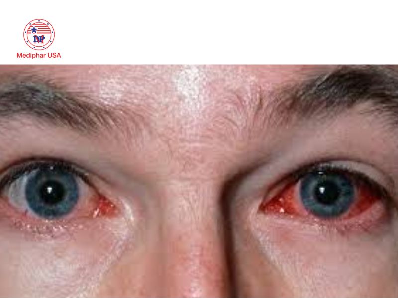 Giác mạc: Cấu trúc, chức năng và các bệnh lý thường gặp Bỏng giác mạc là một bệnh lý nguy hiểm về mắt