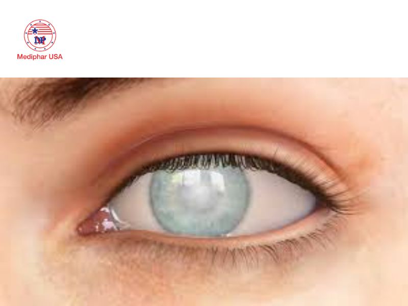 Giác mạc: Cấu trúc, chức năng và các bệnh lý thường gặp Loạn dưỡng giác mạc gây nguy hại cho mắt