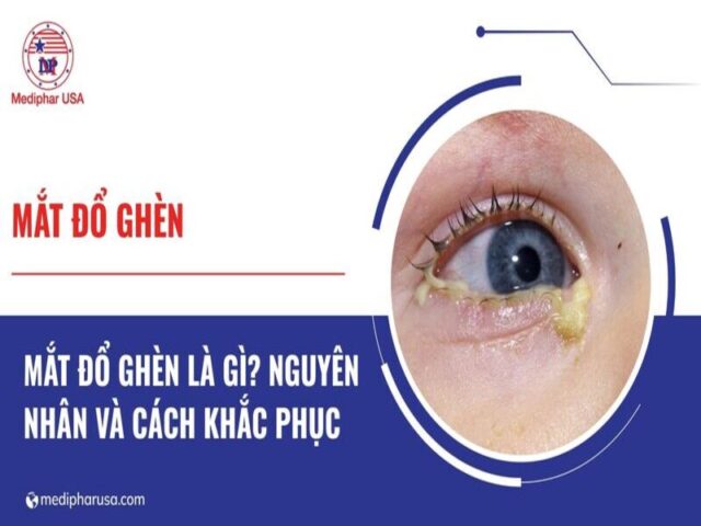 mắt đổ ghèn