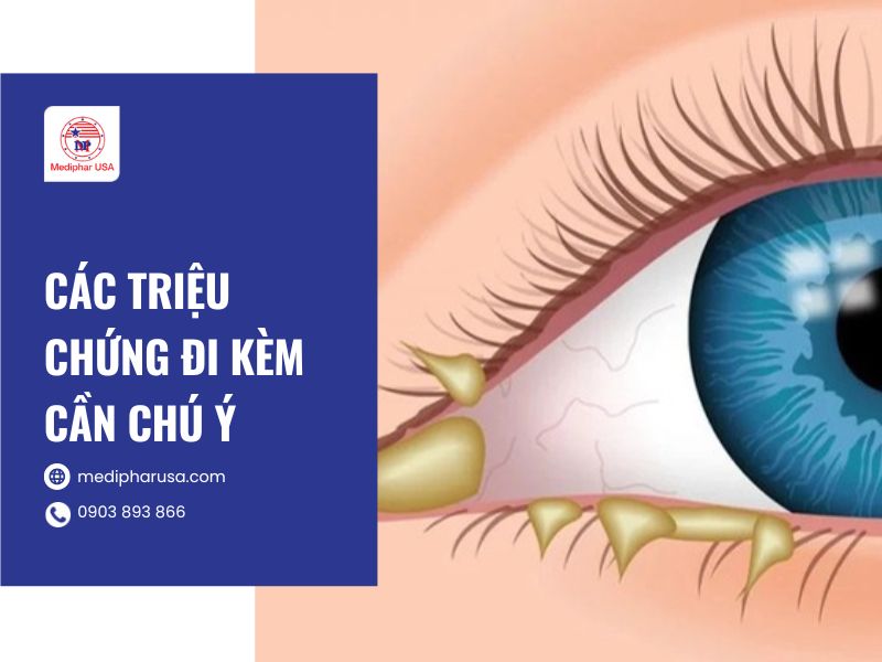 Mắt đổ ghèn bị là gì? Tìm hiểu nguyên nhân và cách khắc phục Các triệu chứng đi kèm cần chú ý khi bị mắt đổ ghèn