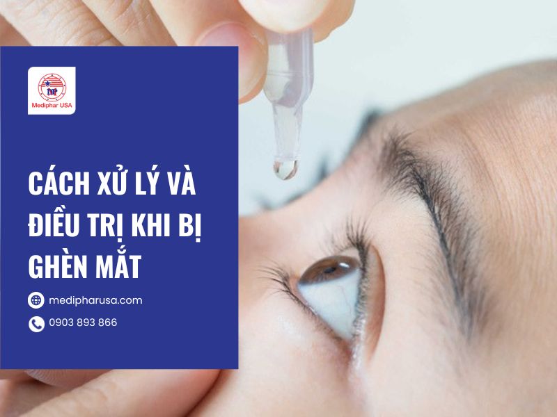 Mắt đổ ghèn bị là gì? Tìm hiểu nguyên nhân và cách khắc phục Cách xử lý và điều trị khi bị ghèn mắt