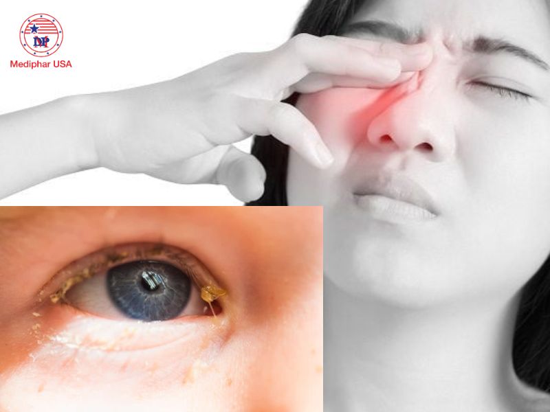 Mắt đổ ghèn bị là gì? Tìm hiểu nguyên nhân và cách khắc phục Bị ghèn mắt là tình trạng phổ biến mà nhiều người gặp phải