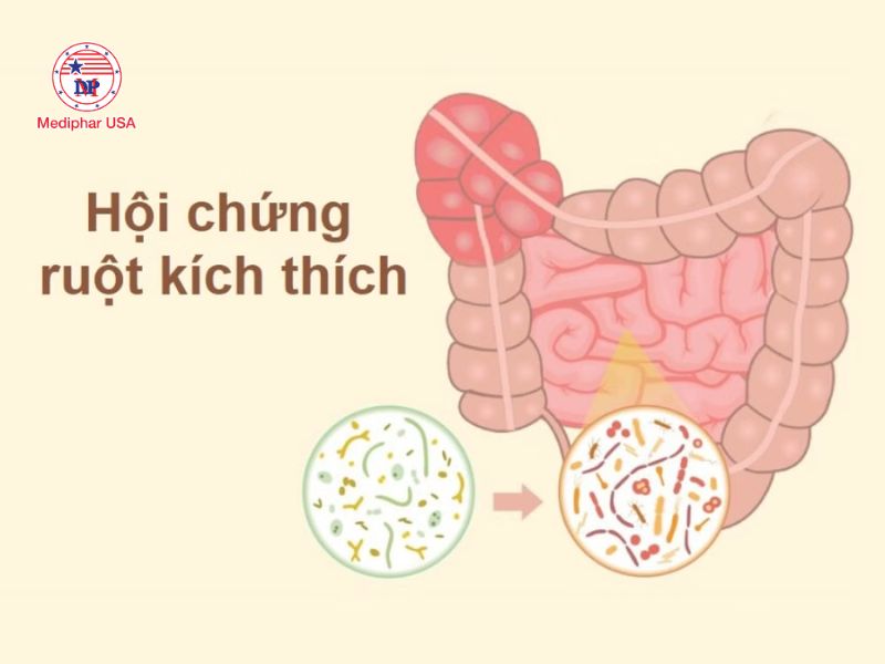 Hội chứng ruột kích thích là một trong những nguyên nhân bệnh lý gây xì hơi nhiều