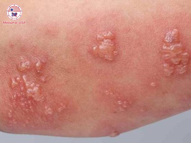 Bệnh Celiac là gì? Nguyên nhân, triệu chứng và cách điều trị Bệnh Celiac có thể gây các nốt phát ban, ngứa, phồng rộp trên da.