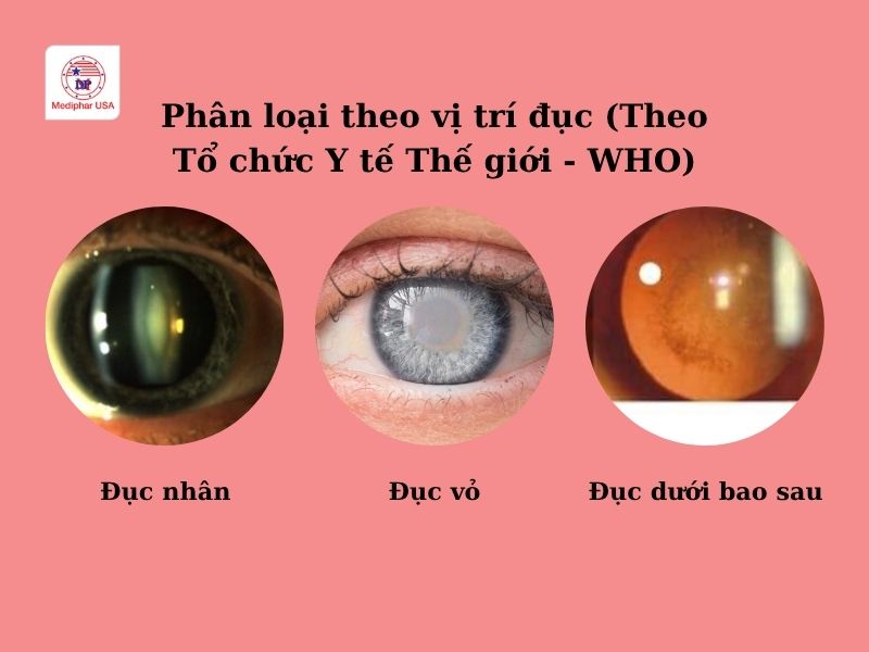 Đục thủy tinh thể ở người già: Nguyên nhân, triệu chứng, điều trị và chi phí Phân loại đục thủy tinh thể theo vị trí gồm đục nhân (ở lõi), đục vỏ (ở lớp vỏ bên ngoài) và đục dưới bao sau (ở mặt sau).
