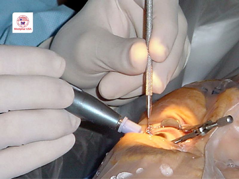 Đục thủy tinh thể ở người già: Nguyên nhân, triệu chứng, điều trị và chi phí Phẫu thuật tán nhuyễn thủy tinh thể bằng siêu âm là phương pháp hiệu quả nhất với đục thủy tinh thể người già.