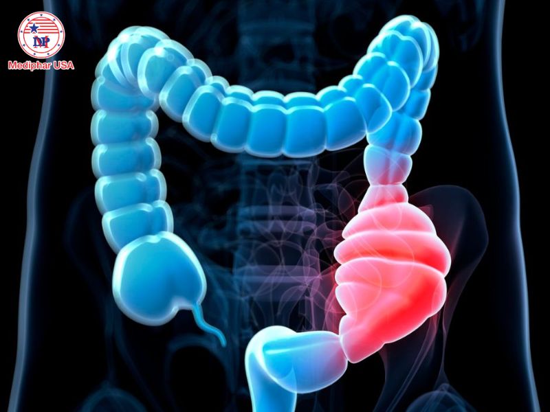Hỏi đáp: Men tiêu hóa có trị được táo bón không? Táo bón là tình trạng khó đi tiêu và số lần đi ít hơn 3 lần/tuần.