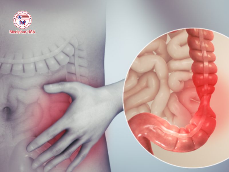Tăng nhu động ruột là gì? Dấu hiệu nhận biết và cách xử lý đơn giản, hiệu quả Tăng nhu động ruột là sự gia tăng hoạt động của ruột