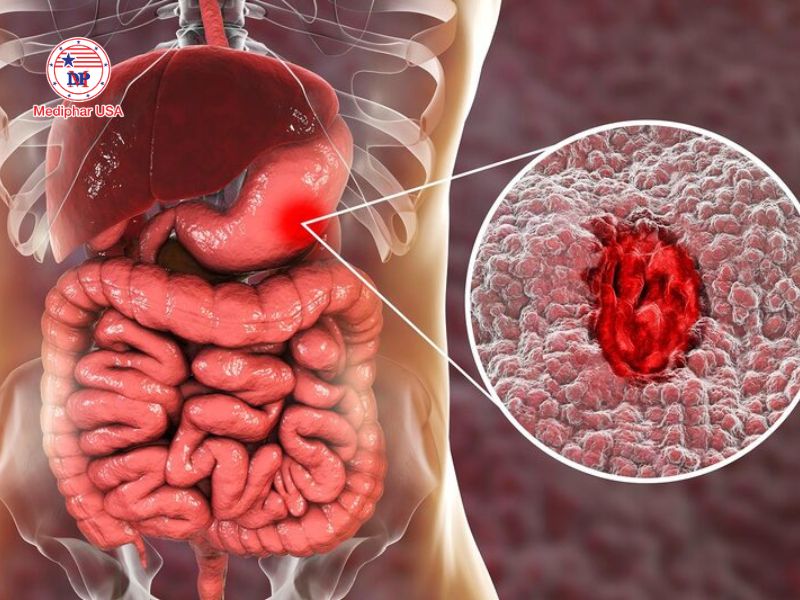 Tăng nhu động ruột là gì? Dấu hiệu nhận biết và cách xử lý đơn giản, hiệu quả Xuất huyết tiêu hóa là một trong những bệnh lý nguy hiểm nhưng dễ nhầm lẫn