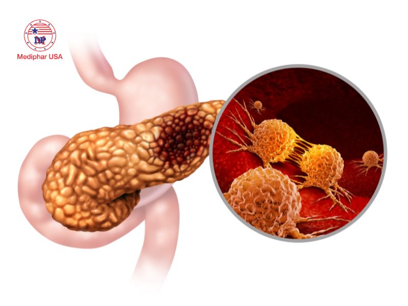 Lipase là gì? Vai trò, cơ chế hoạt động và ứng dụng thực tiễn Khi nồng độ lipase cao gợi ý tình trạng viêm tụy