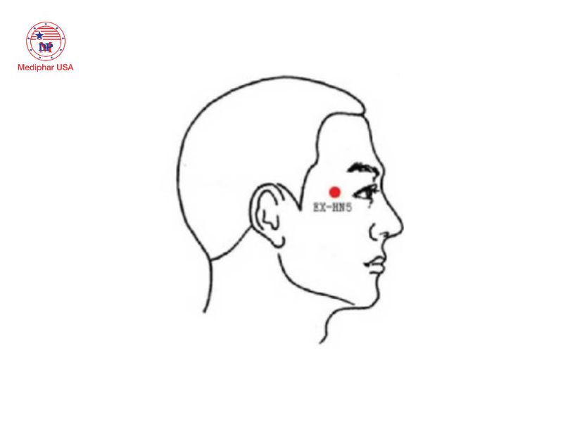 7 huyệt bấm giúp giảm khô mắt, mỏi mắt và làm sáng mắt Huyệt Thái Dương nằm trong chỗ lõm cách điểm giao giữa đuôi lông mày và đuôi mắt