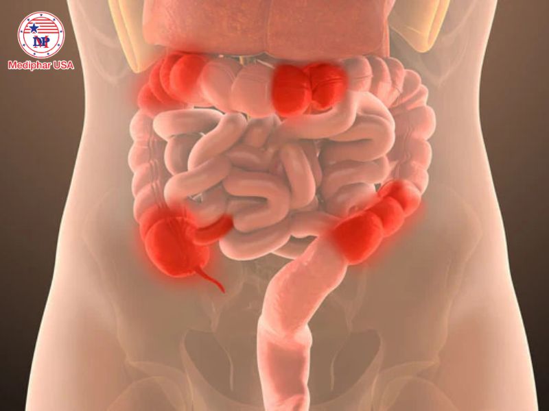Bệnh Crohn là gì? Tìm hiểu nguyên nhân, triệu chứng và cách điều trị Bệnh Crohn là một bệnh mãn tính gây viêm đường tiêu hóa.