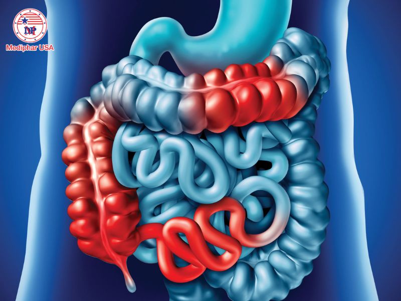 Bệnh Crohn là gì? Tìm hiểu nguyên nhân, triệu chứng và cách điều trị Viêm hồi tràng - manh tràng là dạng phổ biến nhất trong các loại bệnh Crohn.