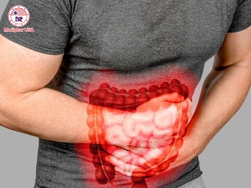 Bệnh Crohn là gì? Tìm hiểu nguyên nhân, triệu chứng và cách điều trị Bệnh Crohn gây đau bụng quặn từng cơn và tiêu chảy kéo dài.