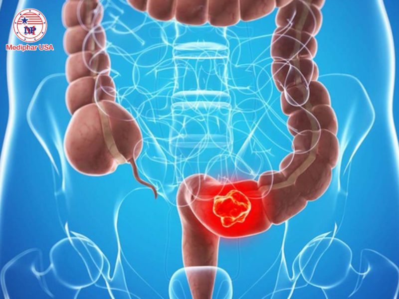 Bệnh Crohn là gì? Tìm hiểu nguyên nhân, triệu chứng và cách điều trị Bệnh Crohn làm tăng nguy cơ mắc ung thư đại - trực tràng.