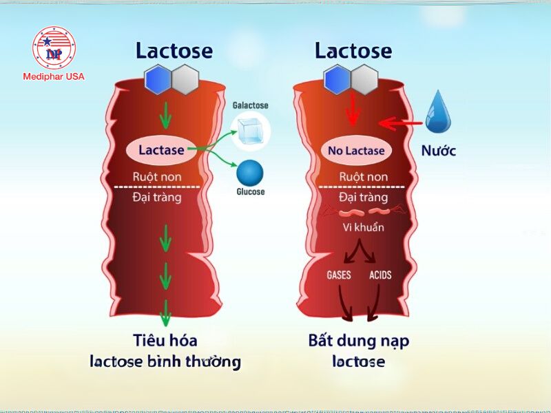 Enzyme lactase là gì? Vai trò, cách bổ sung và lưu ý quan trọng Không dung nạp lactose