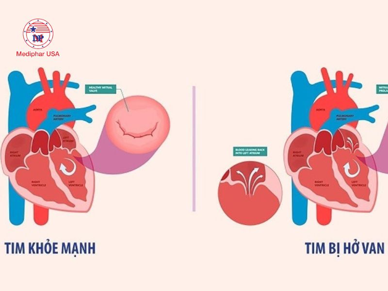 Lactobacillus paracasei là gì? Tác dụng đối với sức khỏe và cách bổ sung hiệu quả Bệnh nhân van tim cần thận trọng khi dùng