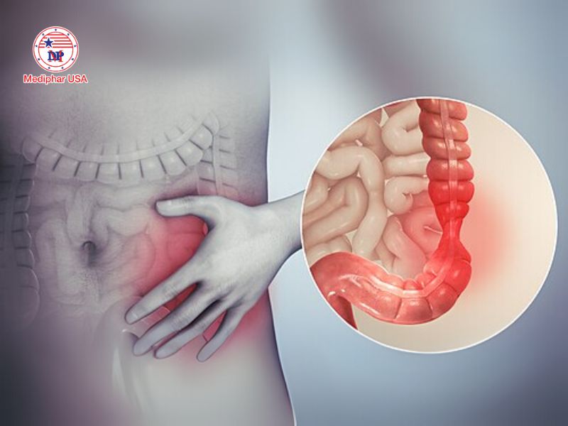 Lợi khuẩn là gì? Các nhóm lợi khuẩn phổ biến và lợi ích với sức khỏe Những người mắc hội chứng ruột kích kích (IBS) có thể bổ sung lợi khuẩn