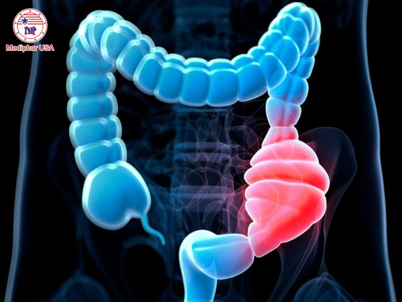 Táo bón là gì? Nguyên nhân, triệu chứng, cách phòng ngừa và điều trị Táo bón là tình trạng số lần đi tiêu ít hơn 3 lần mỗi tuần.