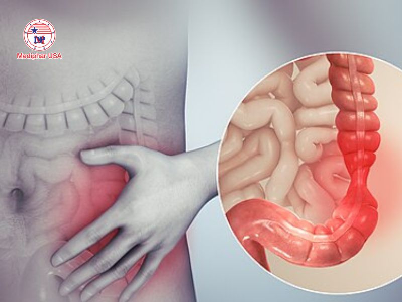 Đi ngoài phân sống là gì? Nguyên nhân, dấu hiệu và hướng dẫn xử lý an toàn Người bị hội chứng ruột kích dễ đi ngoài phân sống