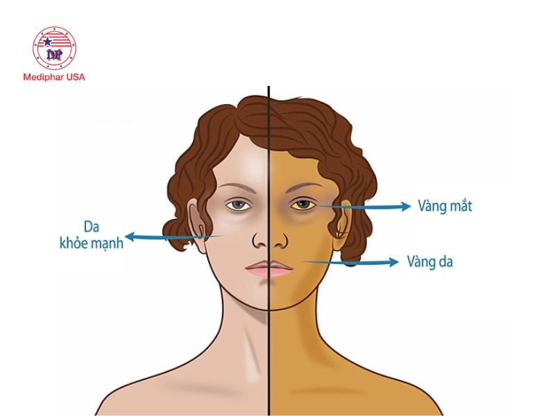 Vàng da, vàng mắt có thể là dấu hiệu cảnh báo vấn đề về tuyến tụy