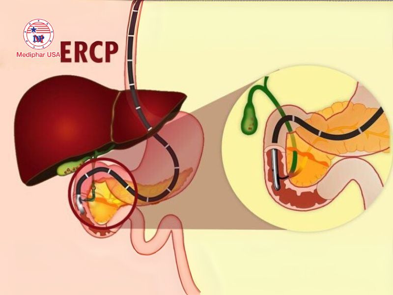 ERCP nội soi mật tụy ngược dòng