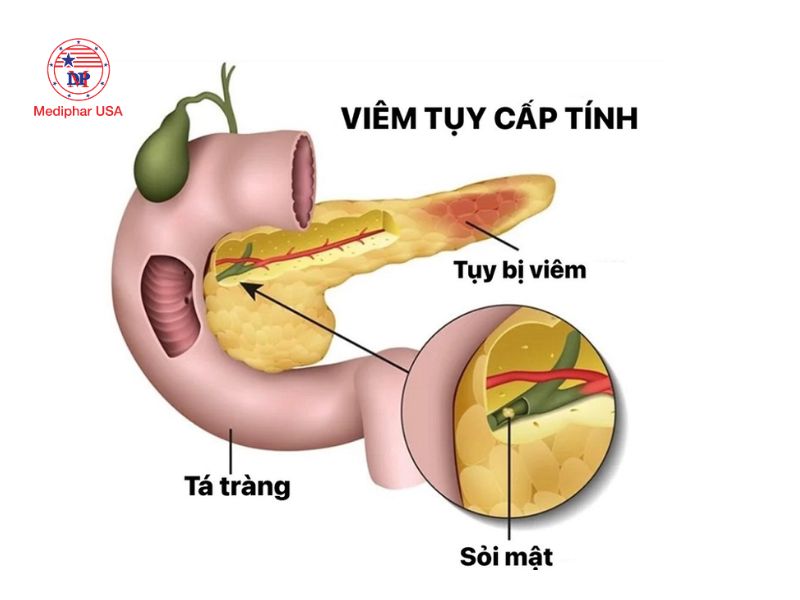 Viêm tụy cấp là tình trạng viêm đột ngột của tuyến tụy