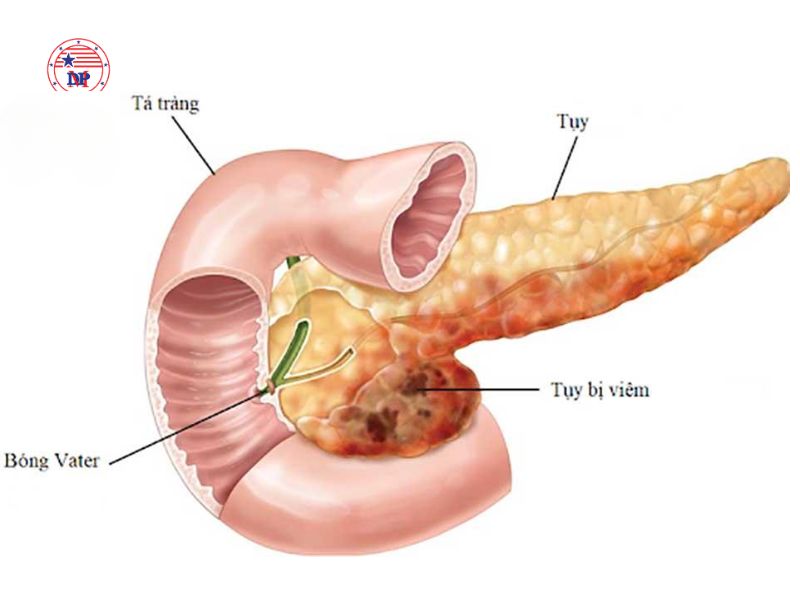Viêm tụy mạn là tình trạng viêm kéo dài và tái đi tái lại nhiều lần