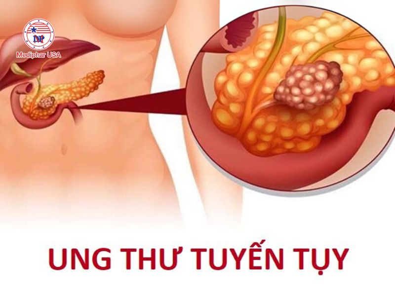 Ung thư ngoại tiết là phổ biến nhất