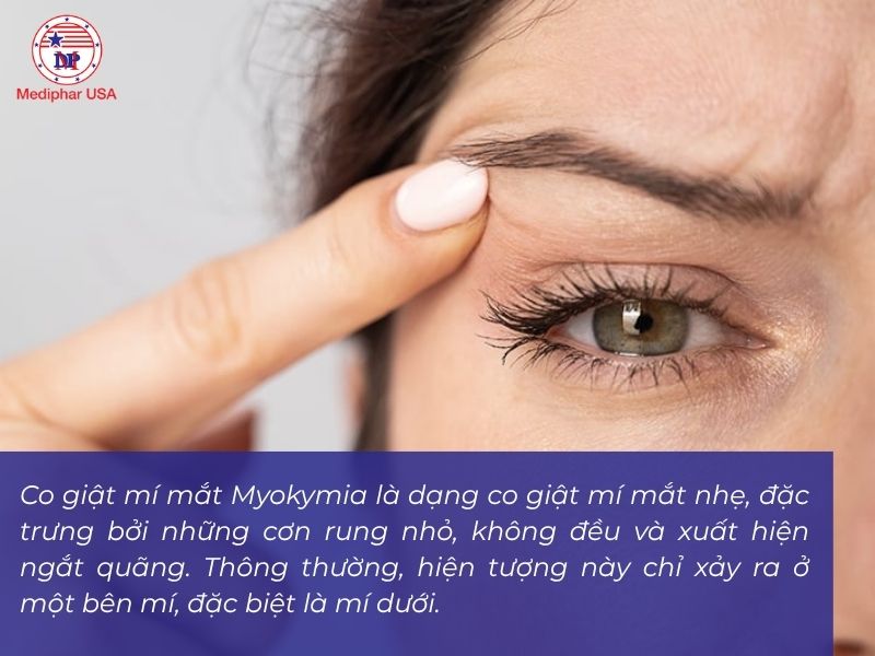 Co giật mí mắt Myokymia rất hay thường gặp chỉ xảy ra một bên mí