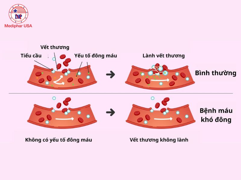Người bị rối loạn đông máu di truyền như hemophilia không nên dùng Alpha Choay