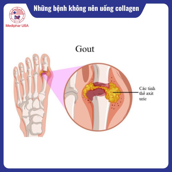 Người mắc bệnh gout việc bổ sung collagen cần được tiếp cận thận trọng
