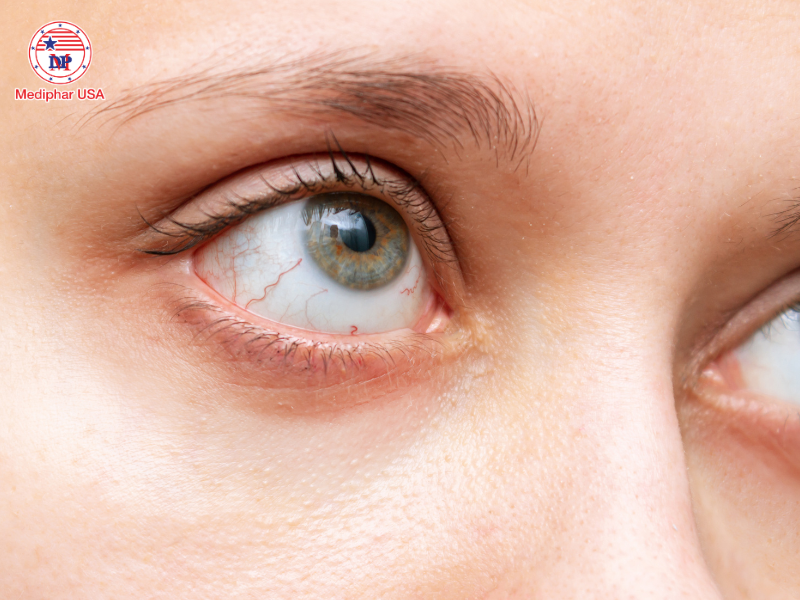 Dầu gấc có tác dụng gì cho mắt?