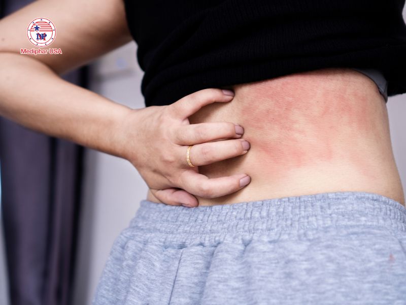 Uống thuốc giải độc gan bị ngứa: Nguyên nhân và cách xử lý phù hợp Da nổi mẩn đỏ, mề đay, ngứa ngáy kéo dài, cần tìm nguyên nhân